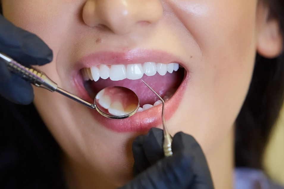 Curdont Early Cavity Detection