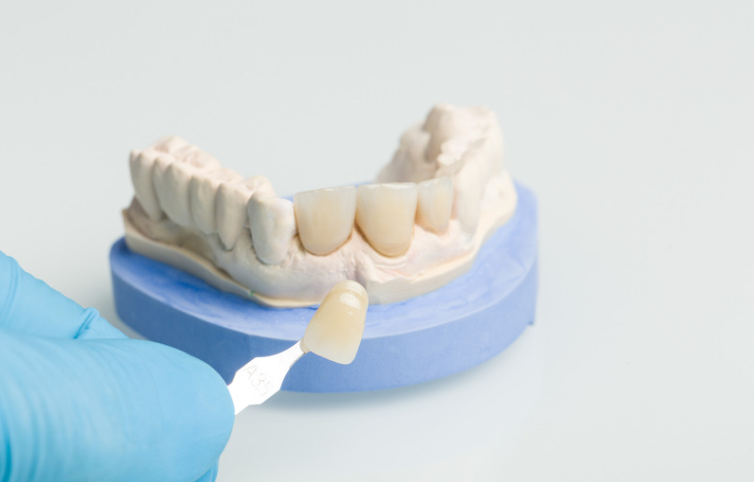 Wondering what dental crowns feel like in Camp Verde AZ? Learn about recovery, fit, and what to expect after your crown procedure. Contact Verde Smiles today.