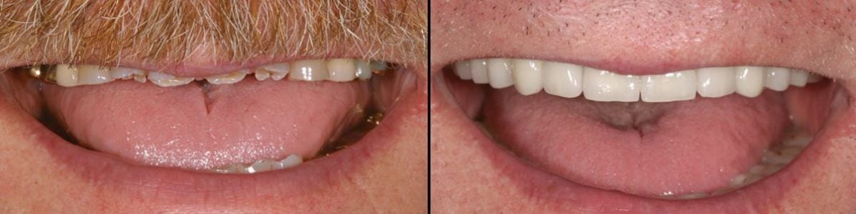 Smile Transformation Verde Smiles 4